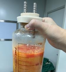 南阳水动力吸脂手术要做多久？
